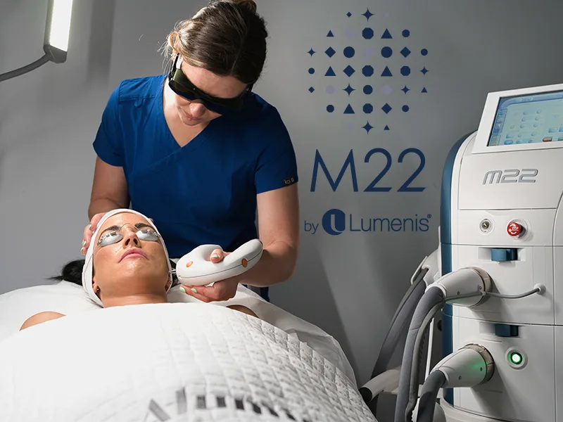 Lumenis M22 IPL treatment for dry eye