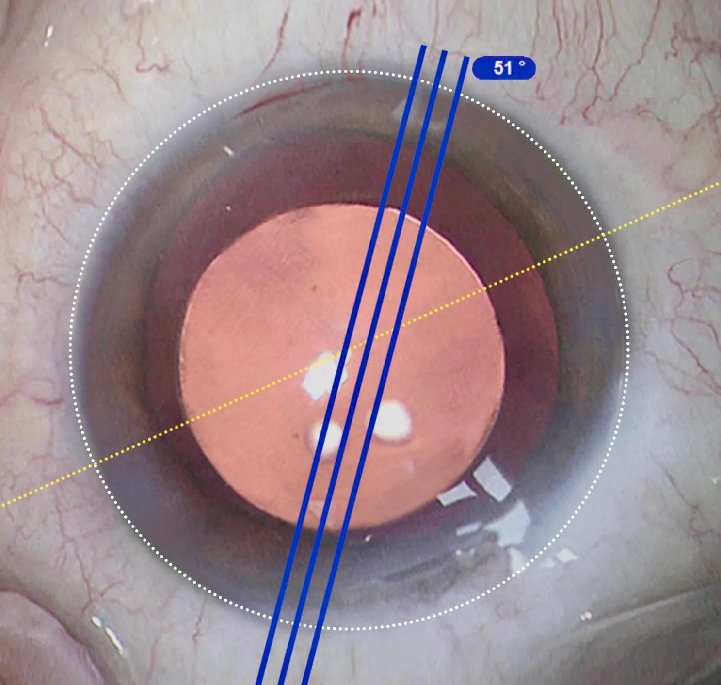 Zeiss Callisto Eye digital alignment during cataract surgery