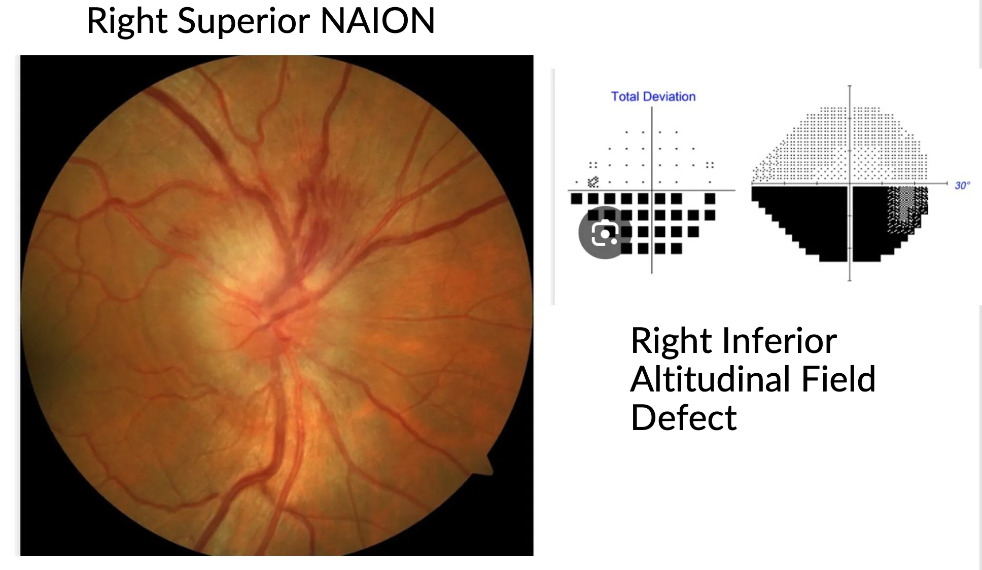 Right superior NAION — fundus photo showing optic disc swelling, with corresponding right inferior altitudinal field defect