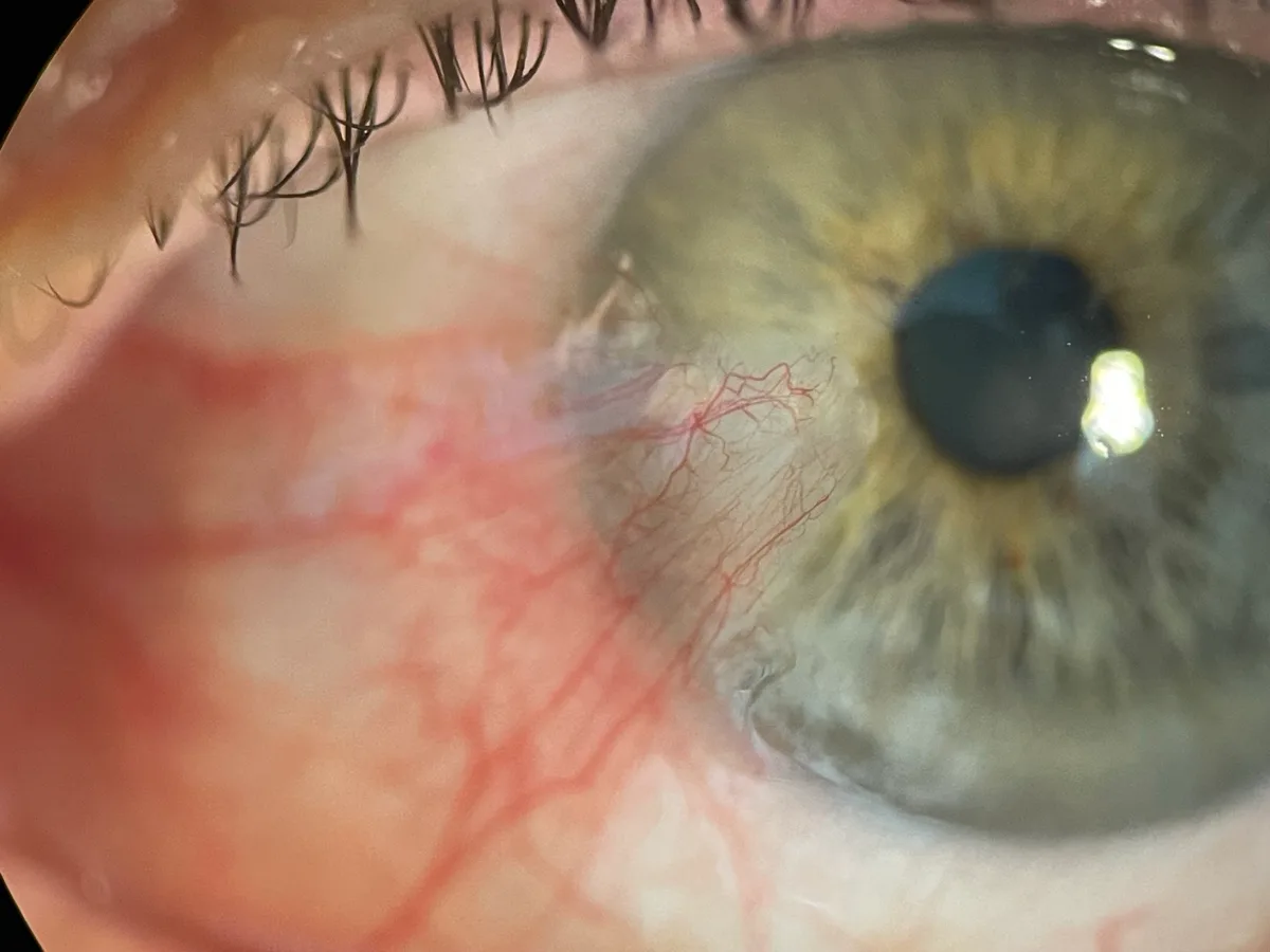 Pterygium growing from the conjunctiva onto the cornea