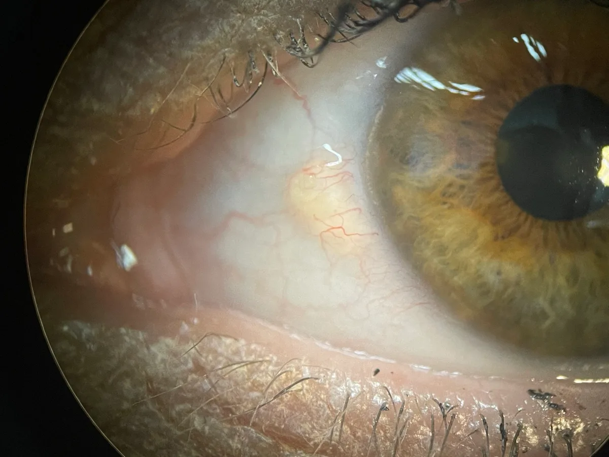 Clinical photograph of a pinguecula — a yellowish raised deposit on the white of the eye that does not cross onto the cornea
