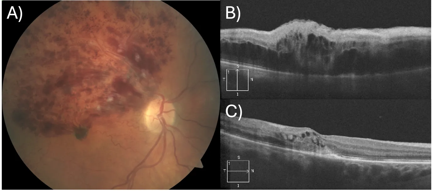 Branch retinal vein occlusion shown on a colour fundus photograph and OCT scans before and after anti-VEGF injection treatment