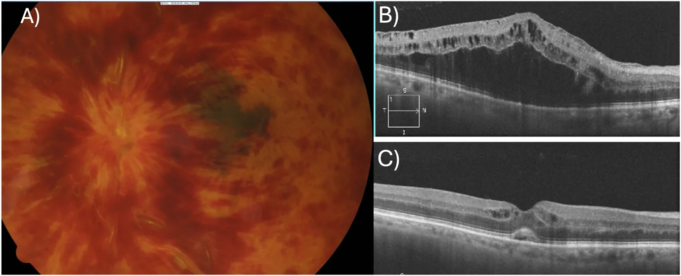 CRVO fundus photo and OCT before and after treatment