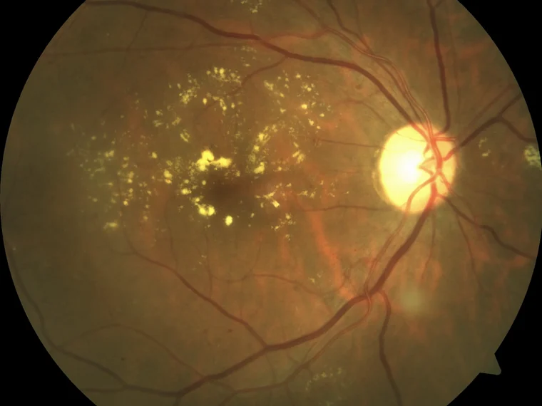 Fundus photograph of diabetic macular oedema with hard exudates ringing the macula