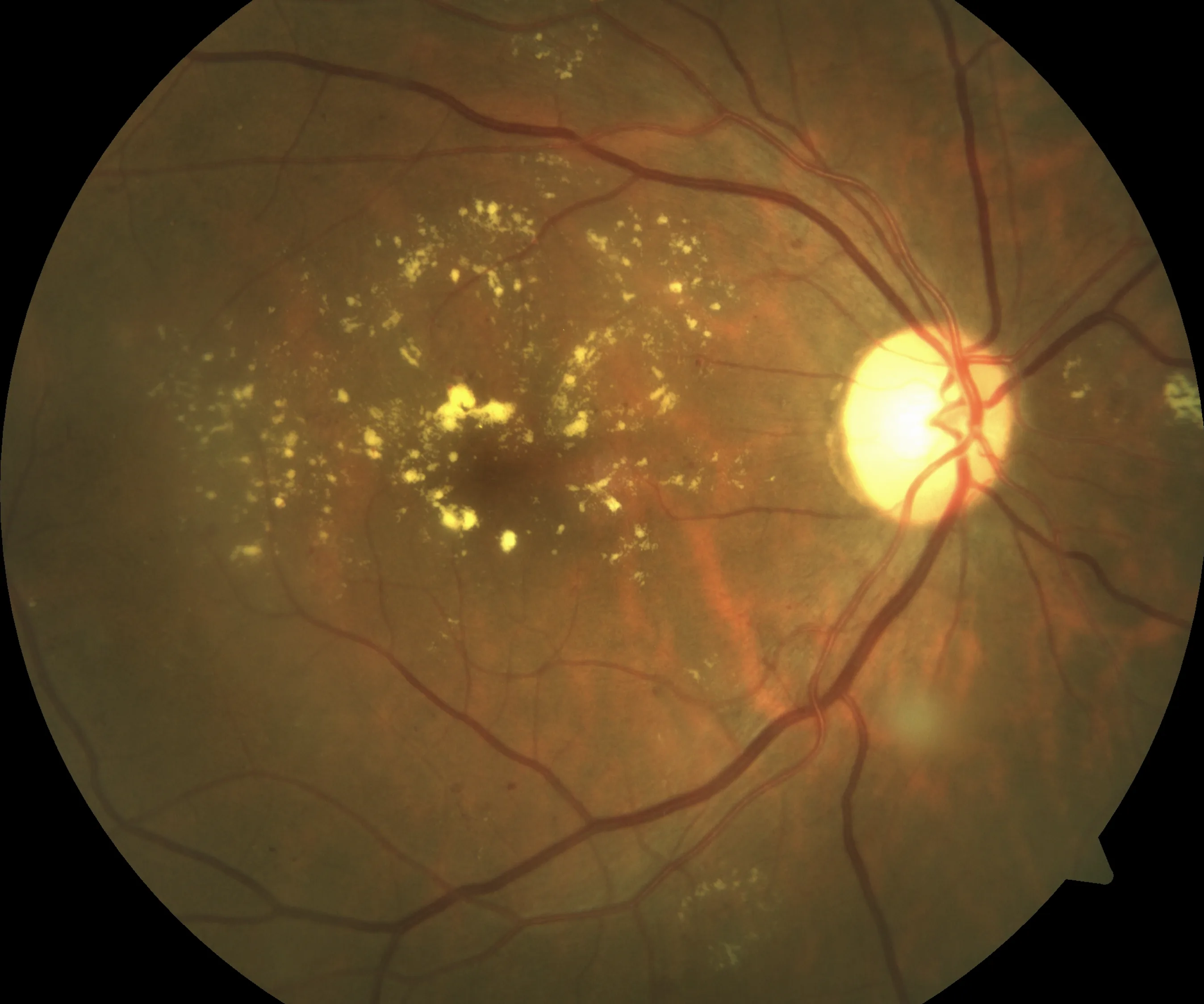Fundus photograph of diabetic macular oedema with hard exudates ringing the macula