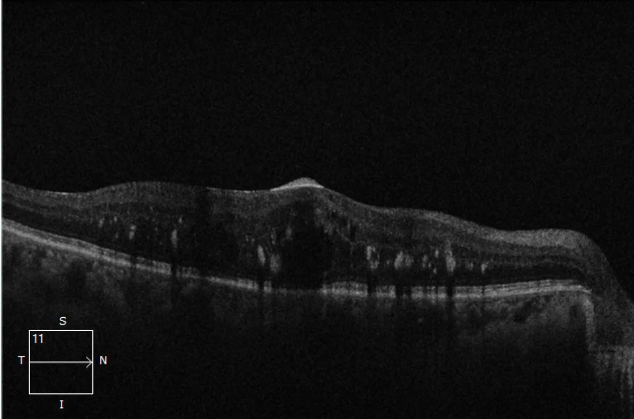 OCT scan showing diabetic macular oedema