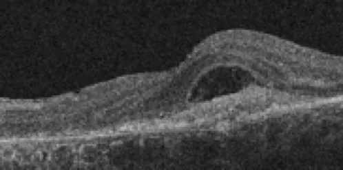 Distorted macula on OCT — fluid or membrane disrupting retinal layers