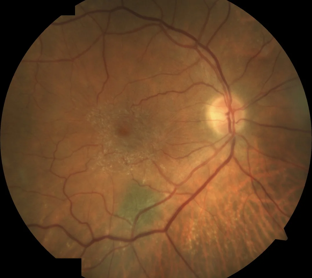 Epiretinal membrane across the macula seen on a retinal photograph
