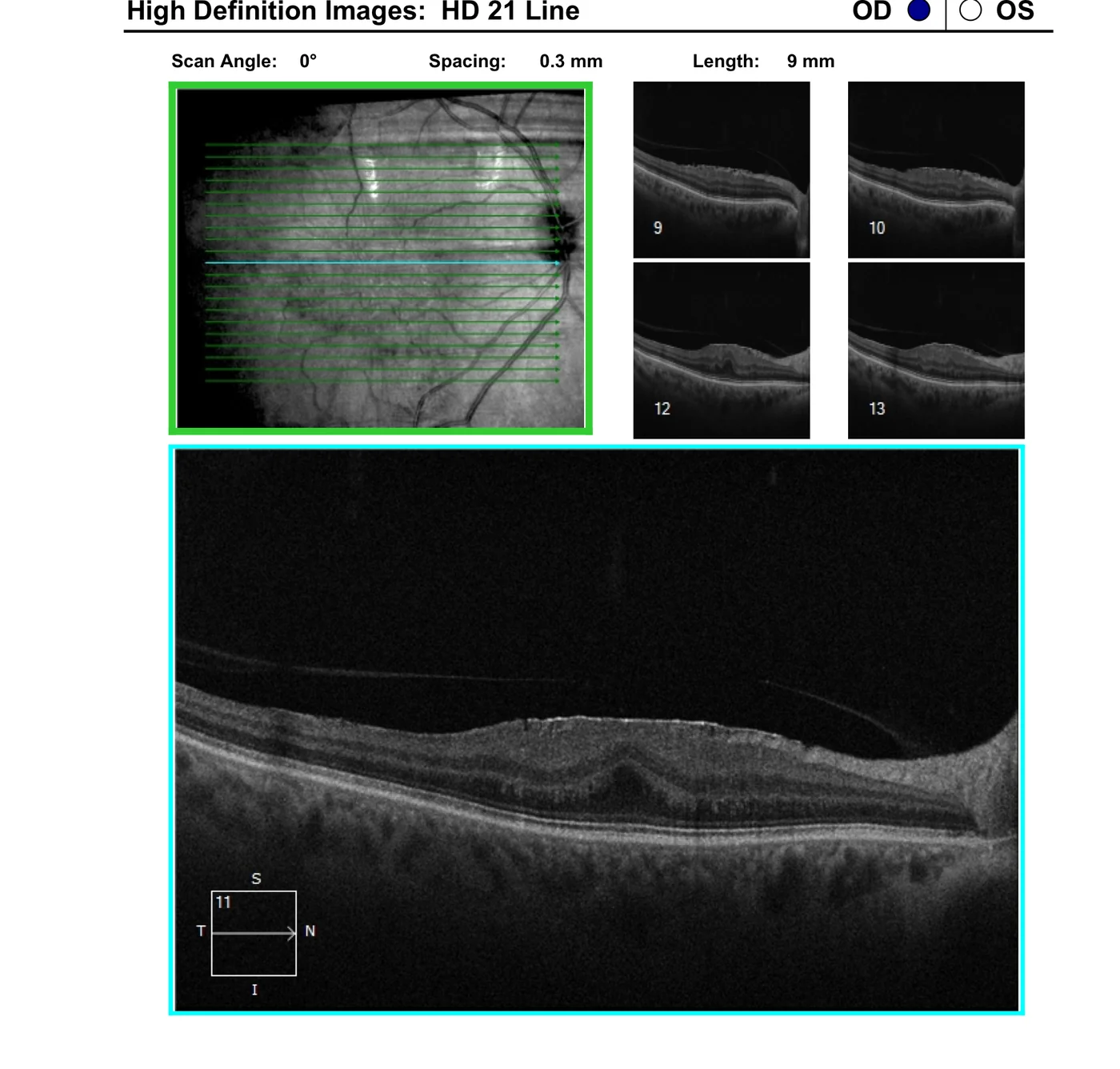 OCT cross-section showing an epiretinal membrane on the retinal surface
