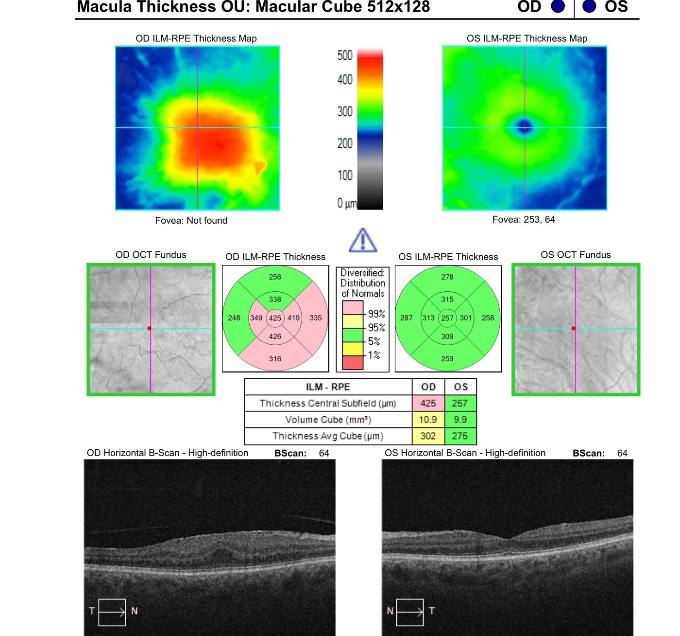 OCT macular thickness map comparing an eye with an epiretinal membrane to the normal fellow eye