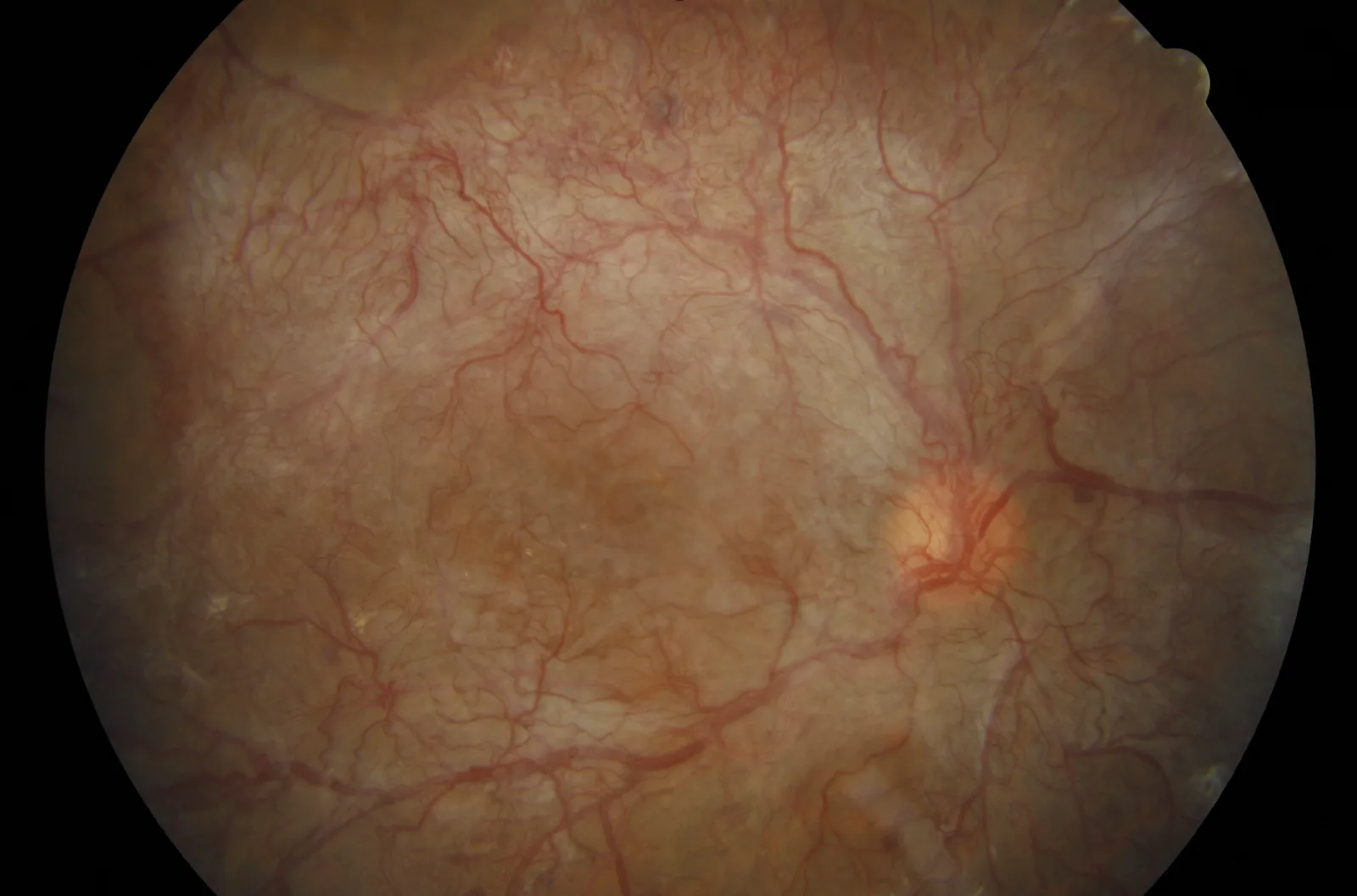 Florid posterior segment neovascularisation in proliferative diabetic retinopathy