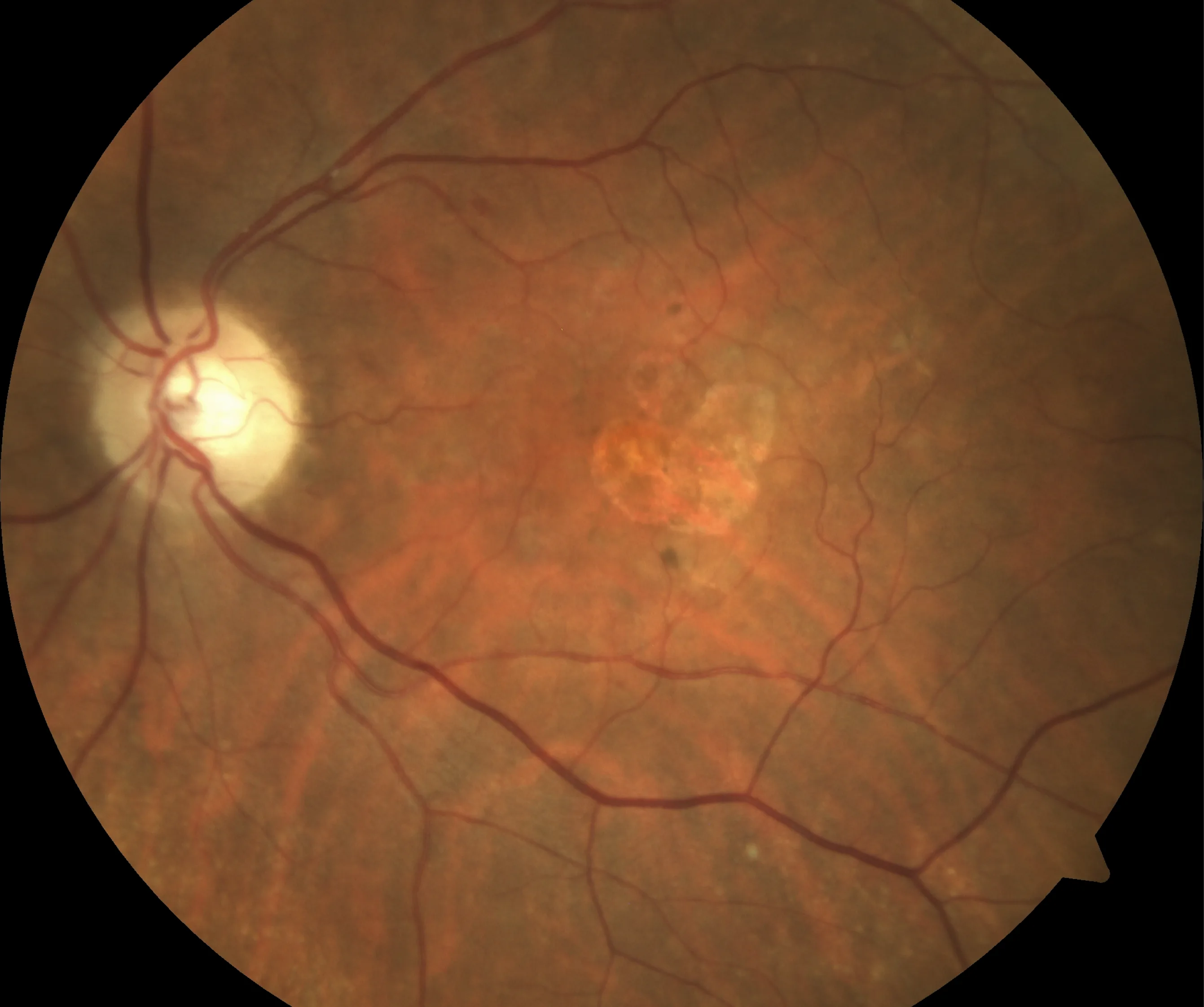 Geographic atrophy affecting central vision