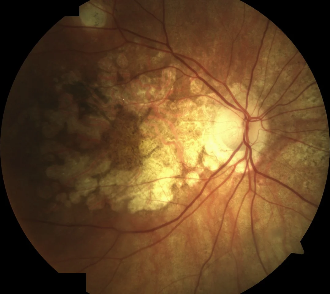 Geographic atrophy advancing toward the central fovea in dry AMD