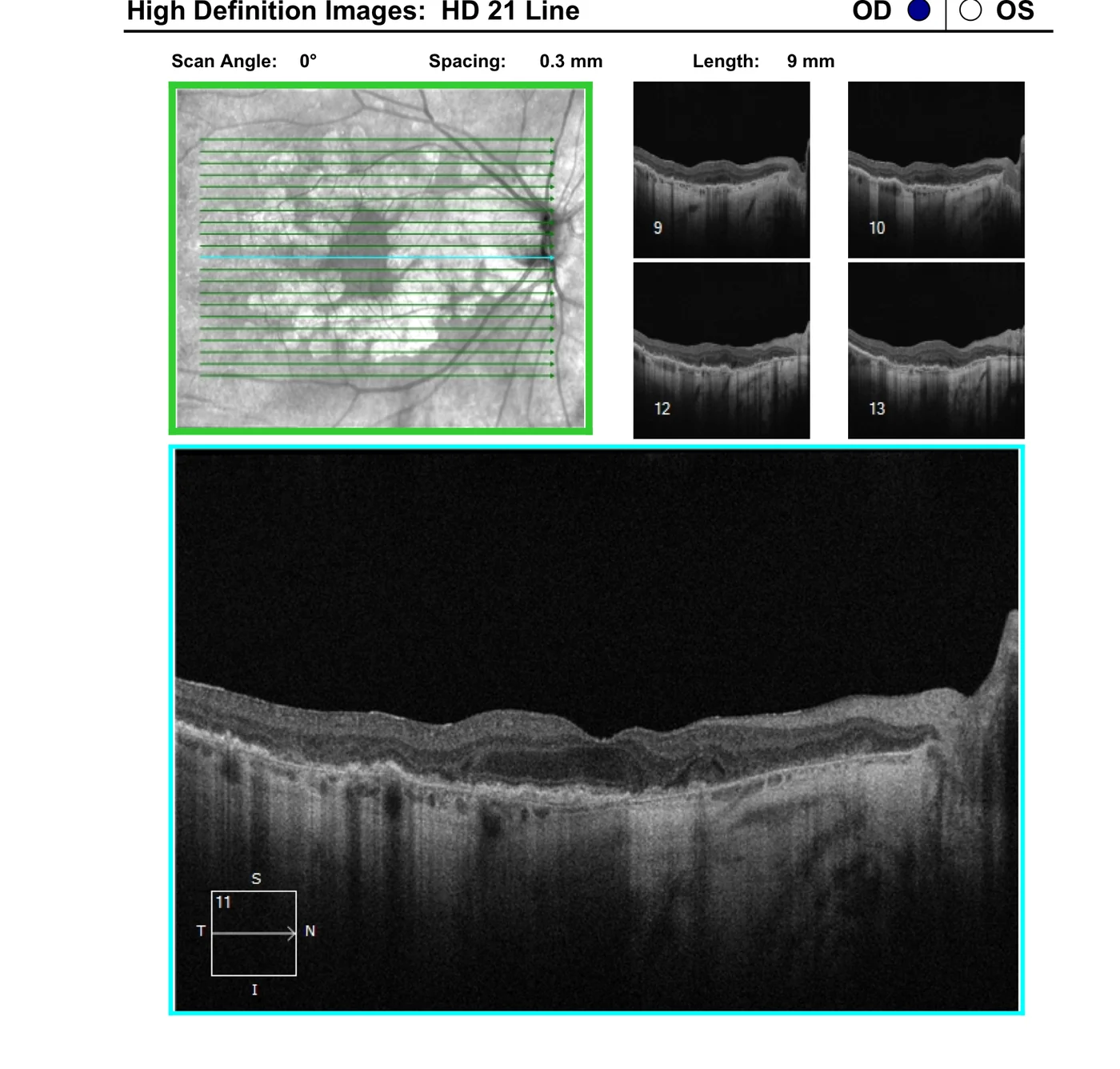 OCT scan through the same eye showing loss of the outer retinal layers and retinal pigment epithelium in geographic atrophy