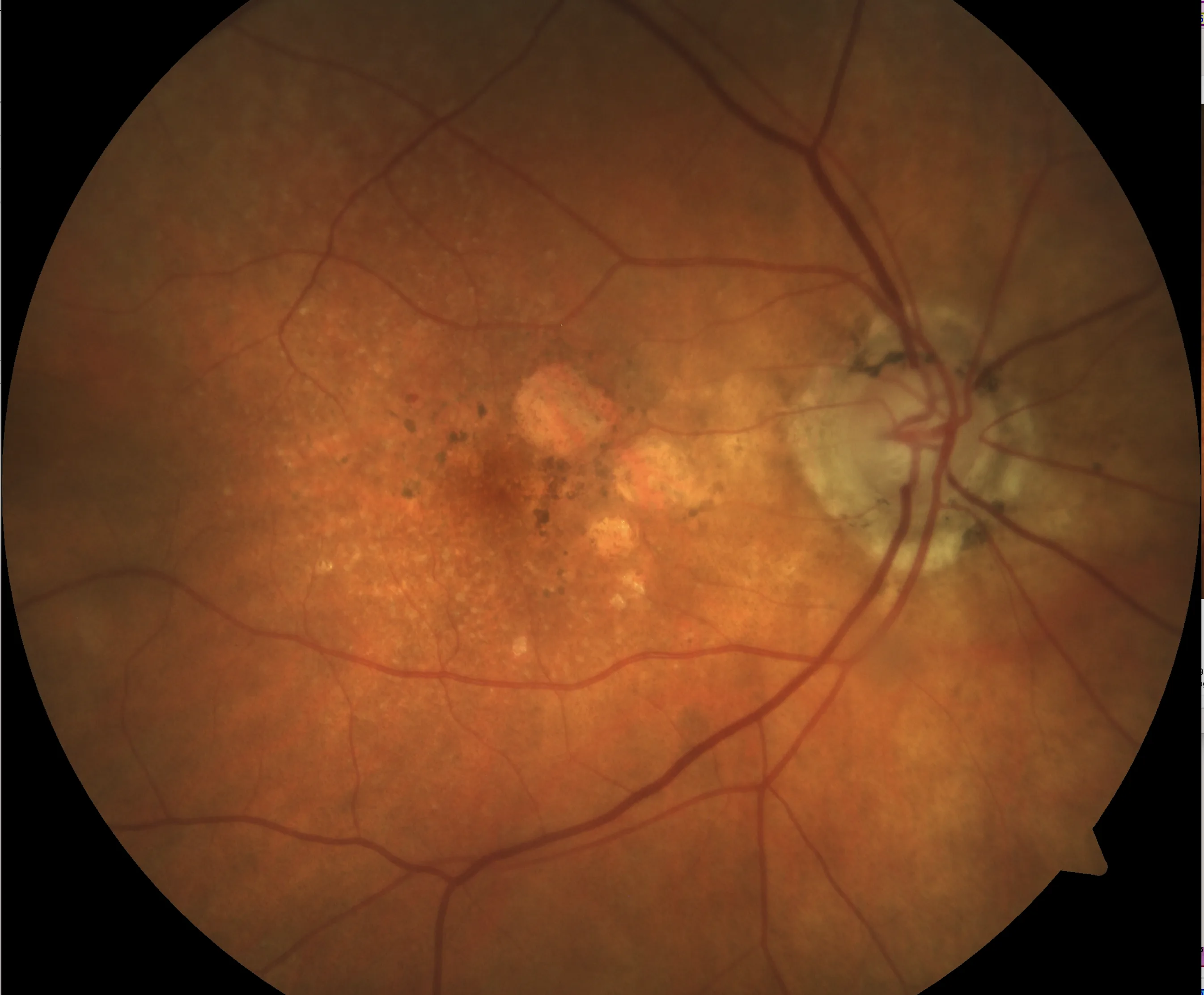 Geographic atrophy approaching the central macula