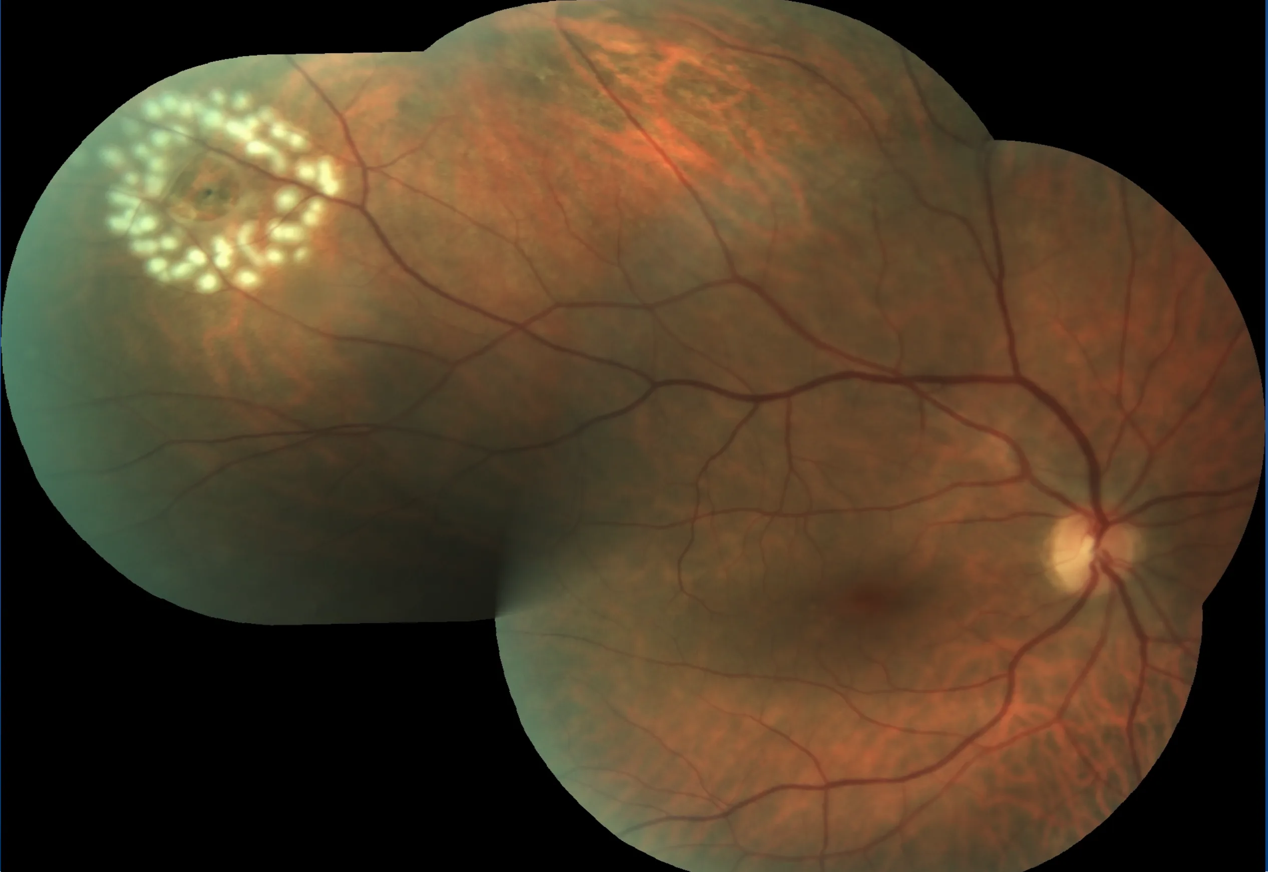 Laser retinopexy surrounding a retinal tear — prompt treatment