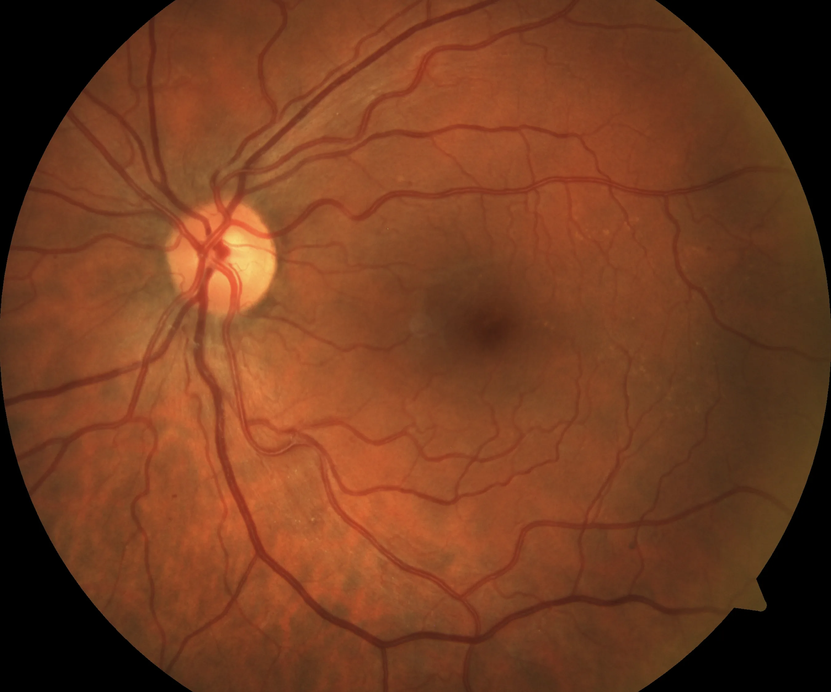 Mild non-proliferative diabetic retinopathy