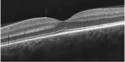 Normal macula on OCT — smooth, flat retinal layers