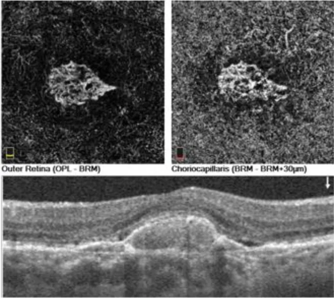 OCT angiography showing a choroidal neovascular membrane — abnormal blood vessel growth beneath the retina