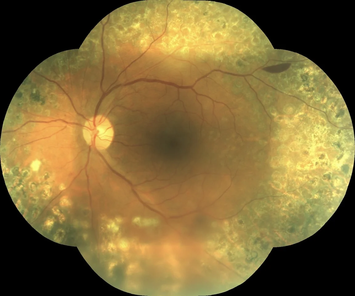 Active proliferative diabetic retinopathy with haemorrhage despite prior panretinal laser