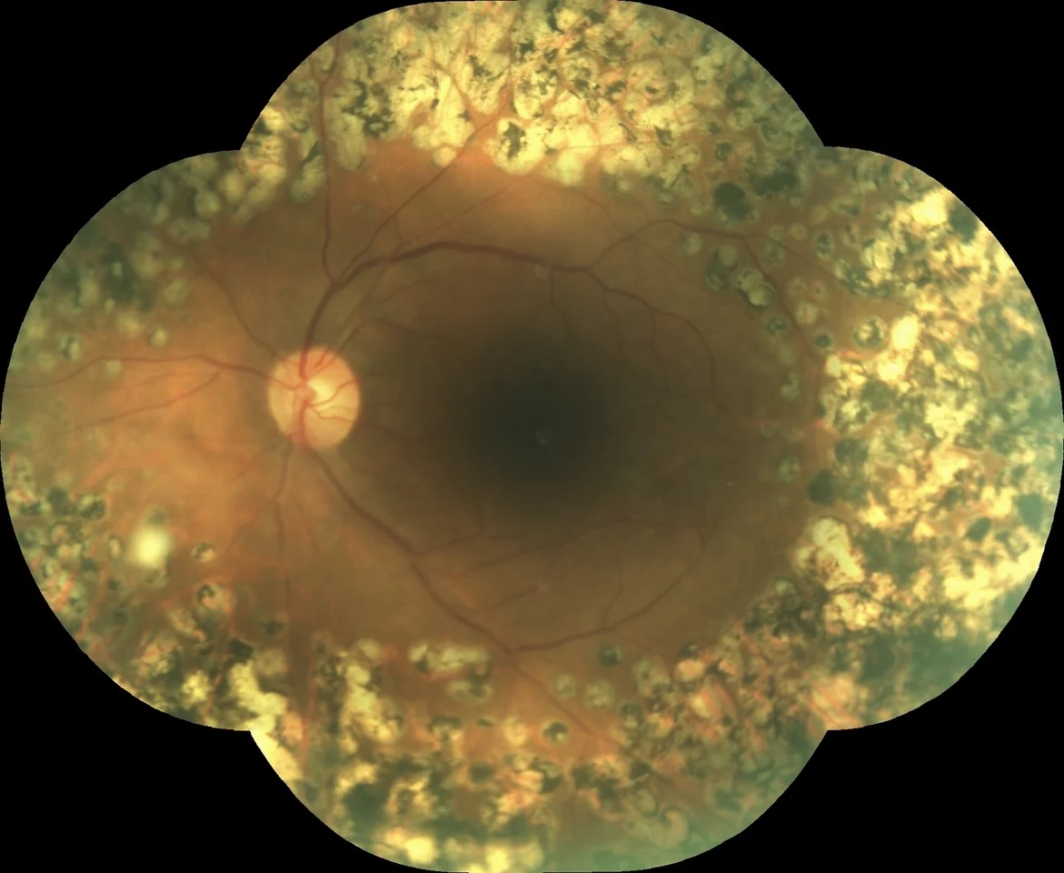 Proliferative diabetic retinopathy regressed after additional panretinal laser