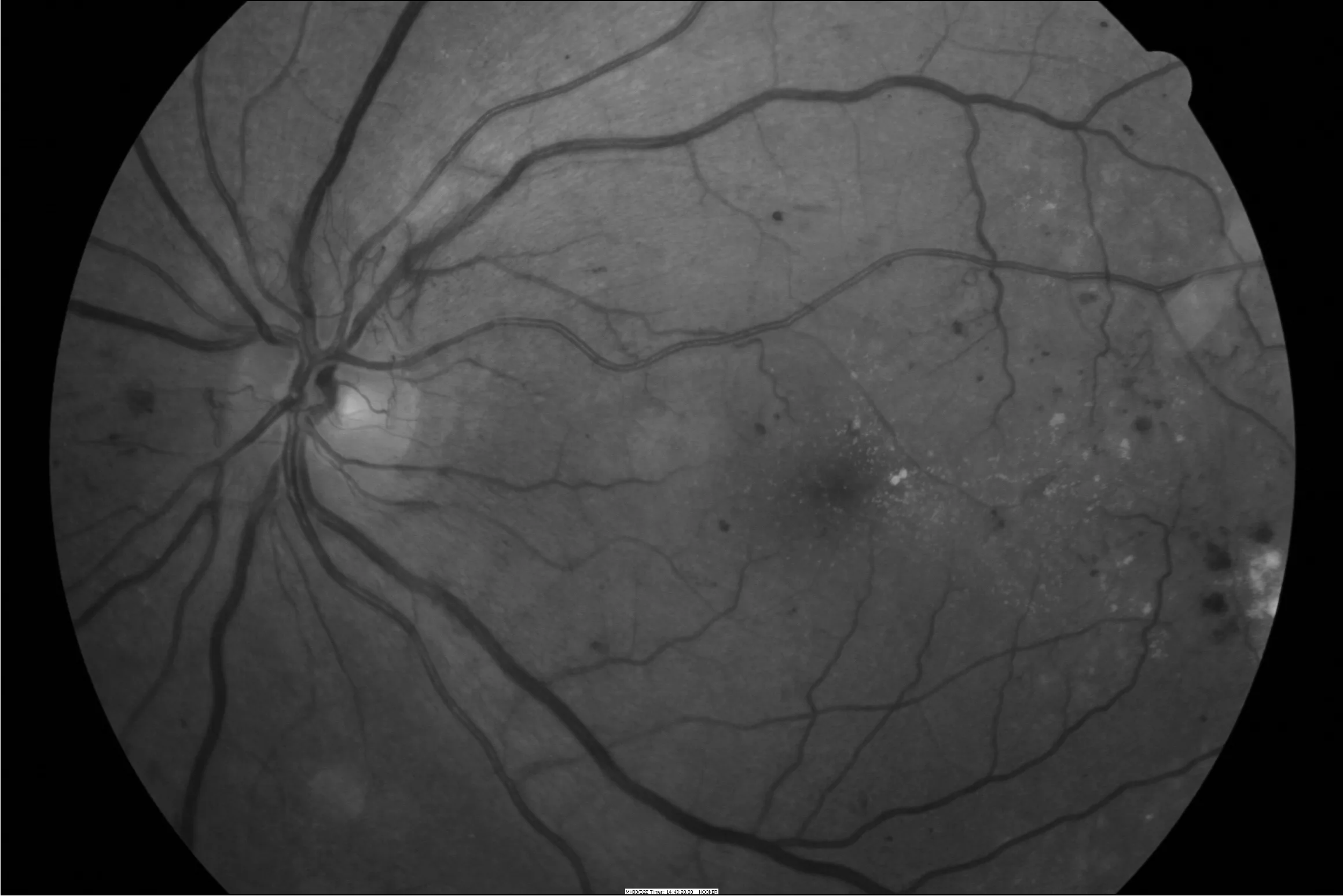 Fundus photograph of proliferative diabetic retinopathy