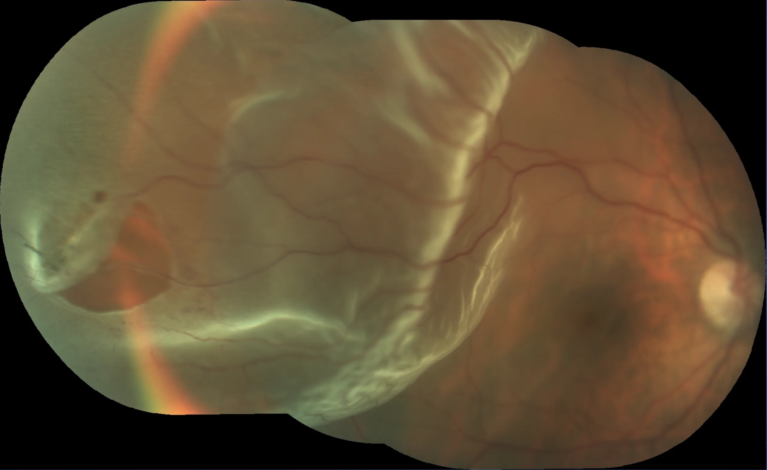 Retinal detachment after ignoring symptoms