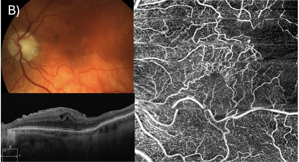 Small macular branch retinal vein occlusion with OCT and OCT-Angiogram