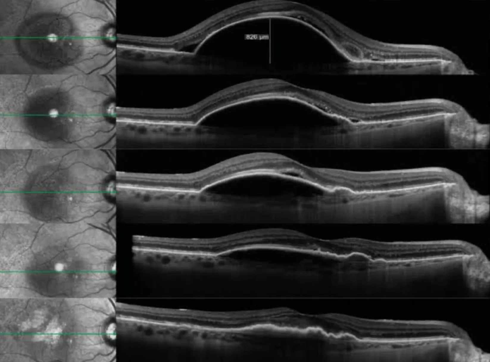 OCT series through wet macular degeneration showing fluid lifting the retina, then settling over successive visits during anti-VEGF treatment