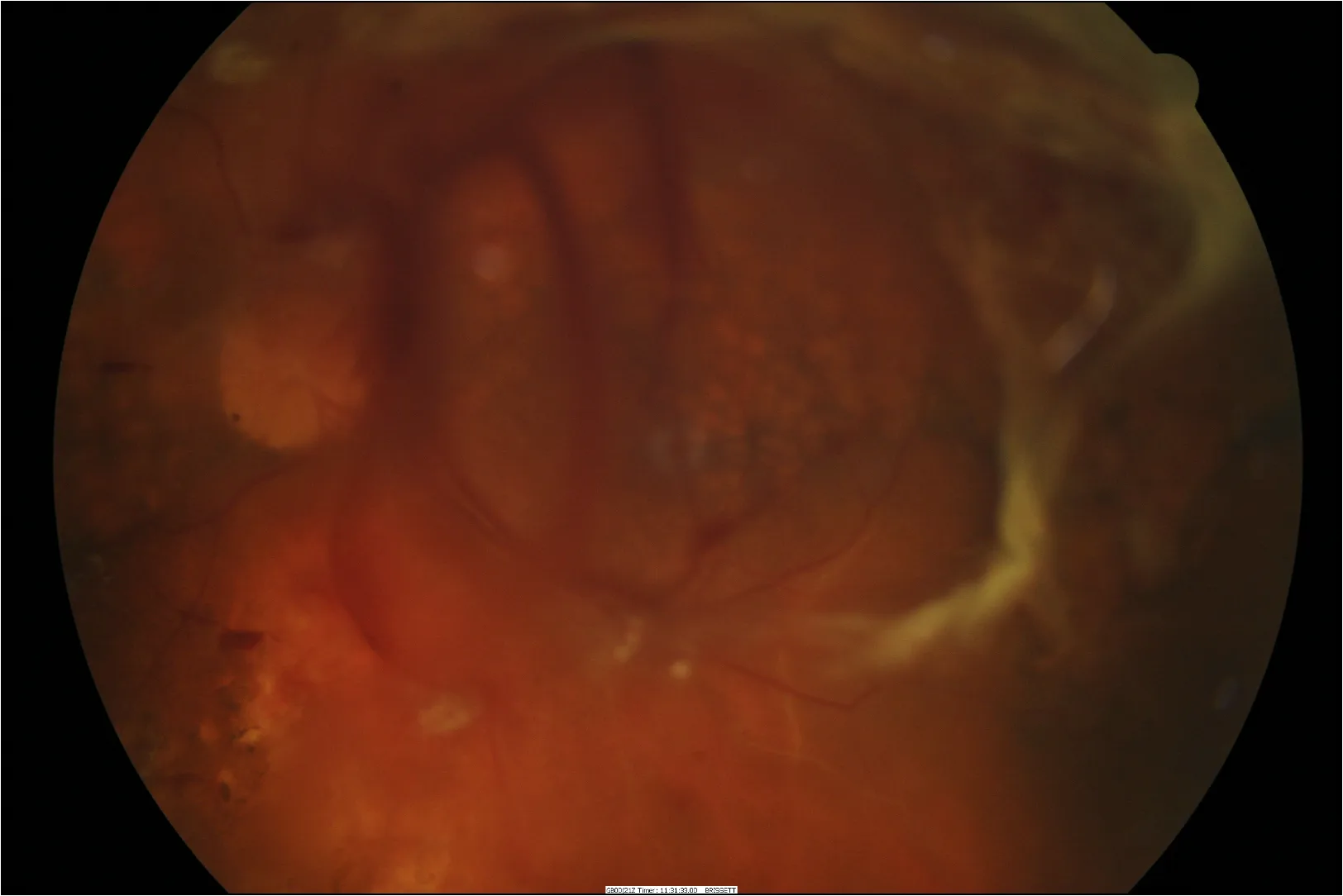 Vitreous haemorrhage from proliferative diabetic retinopathy