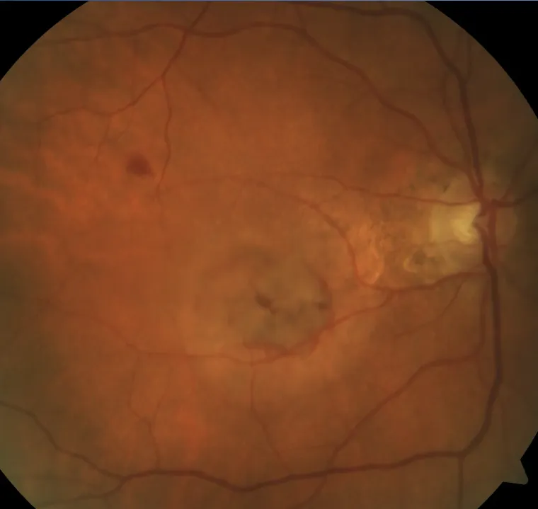 OCT scan of wet macular degeneration showing subretinal fluid