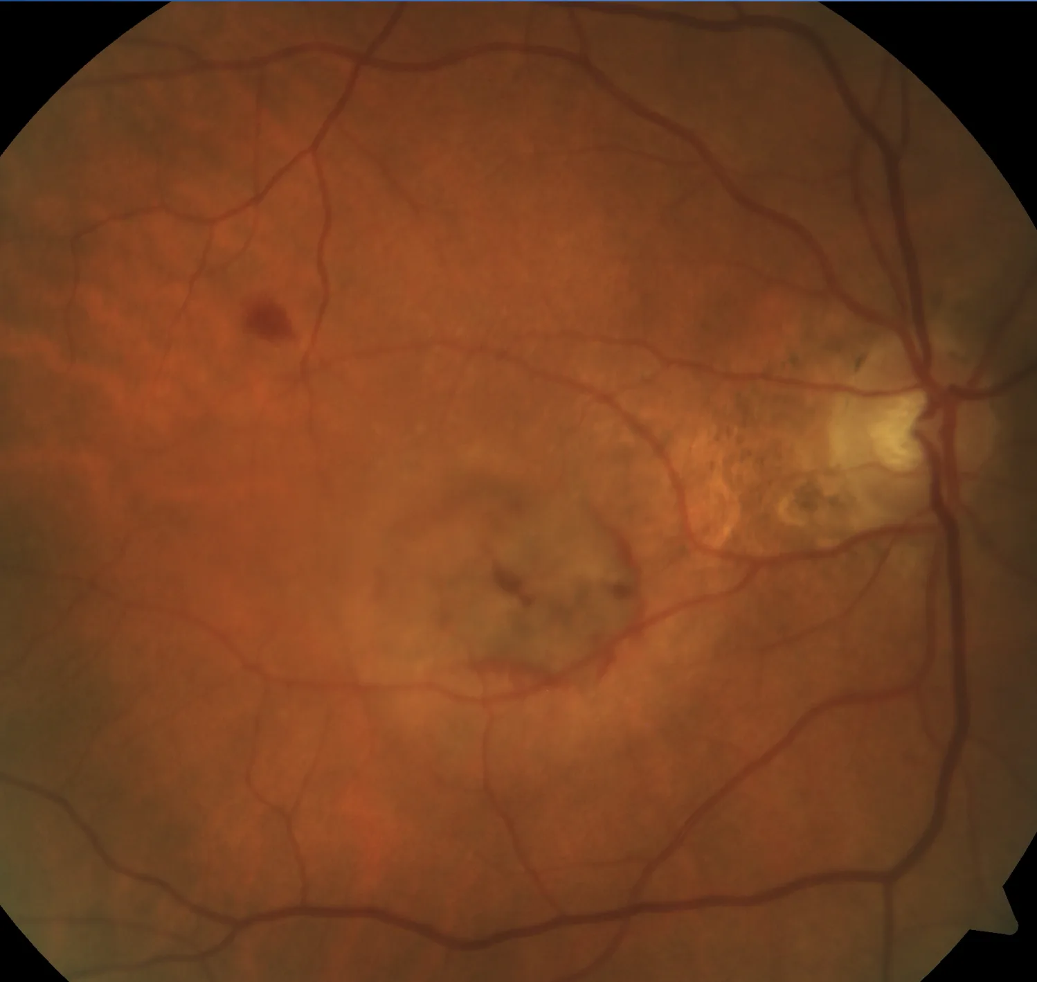 OCT scan of wet macular degeneration showing subretinal fluid