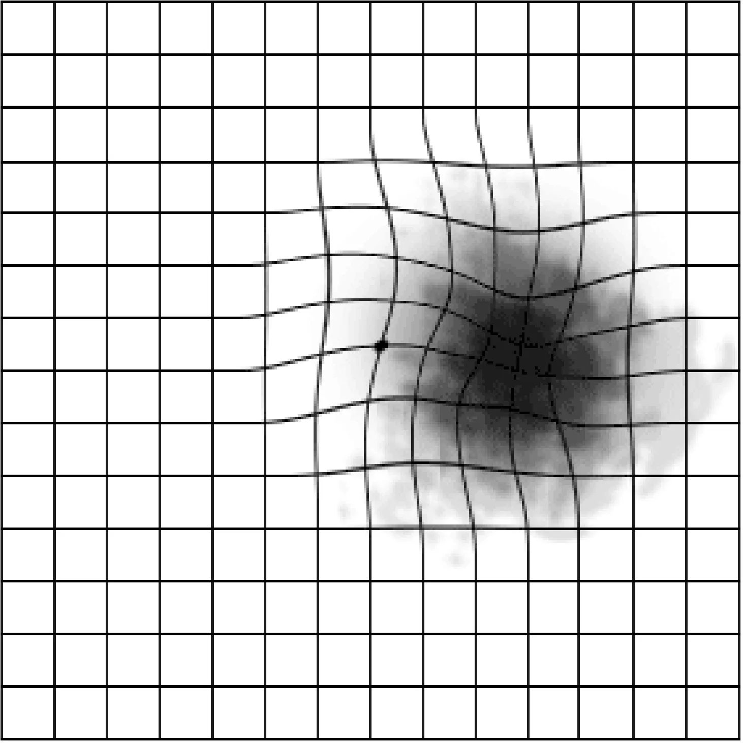 Amsler grid showing distortion