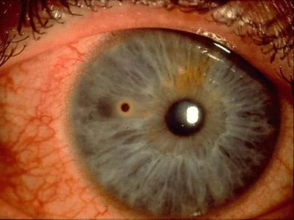 Clinical photograph of a corneal foreign body with rust ring