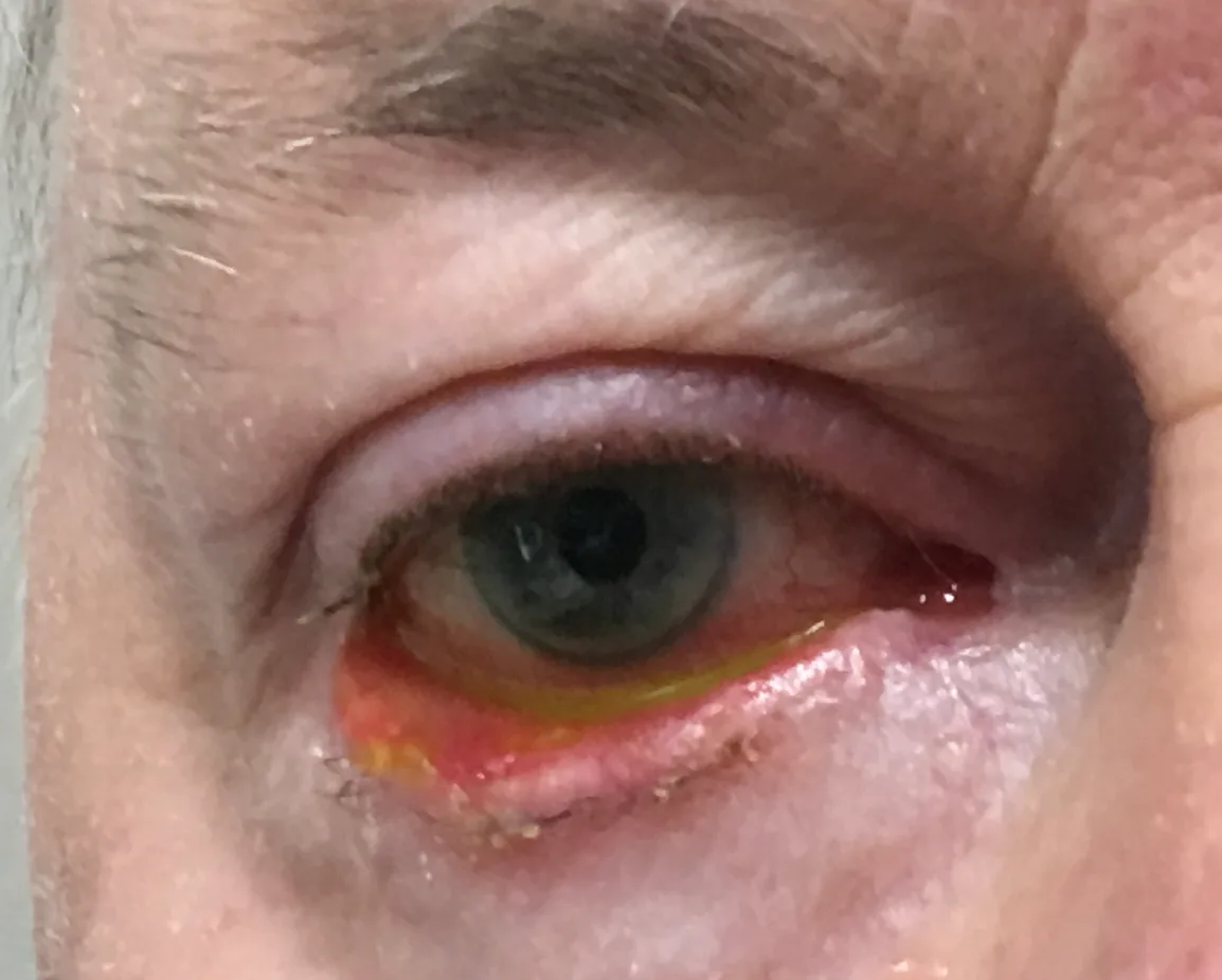 Ectropion — lower eyelid sagging outward away from the eye