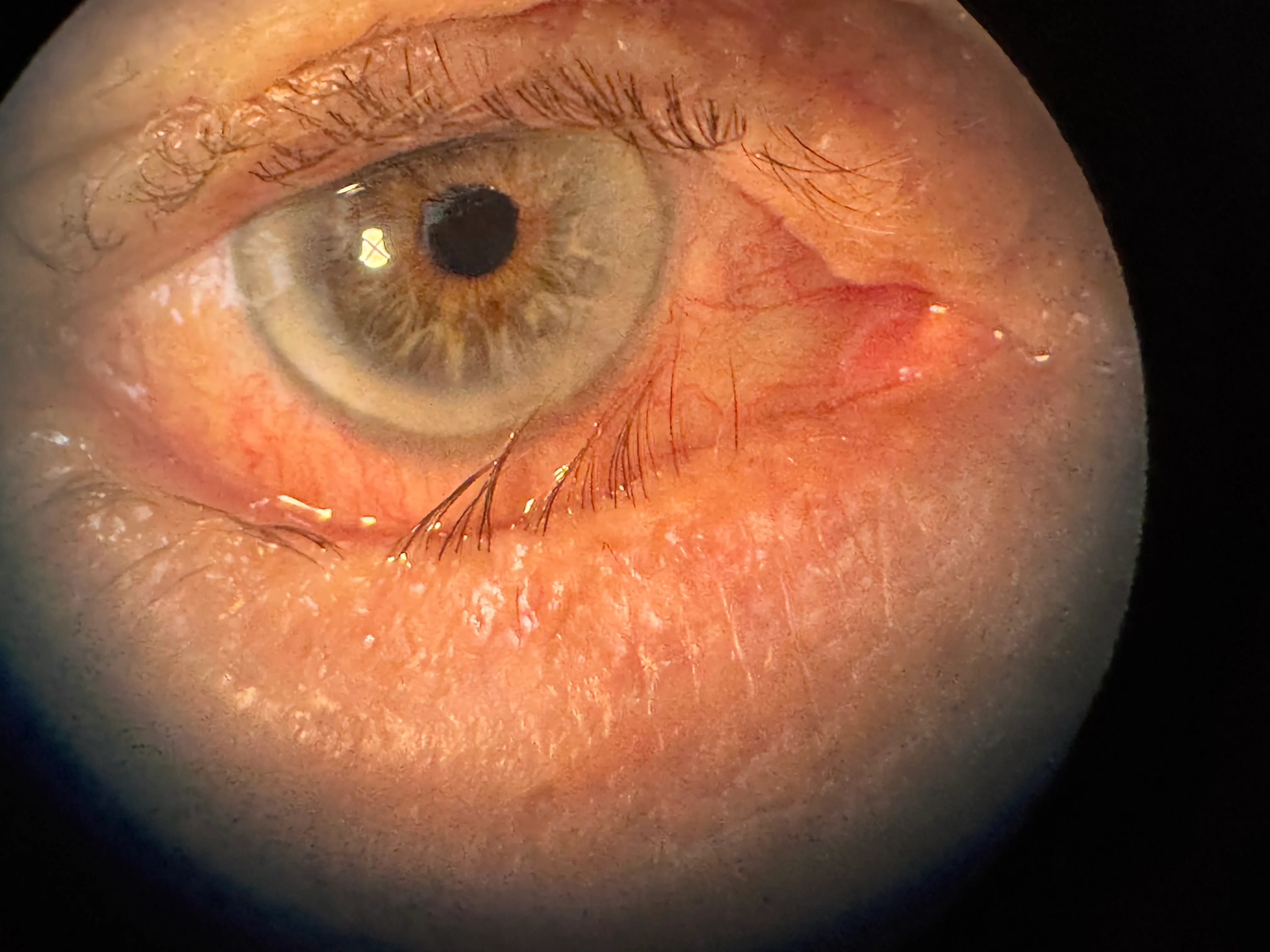 Entropion — lower eyelid rolled inward against the eye