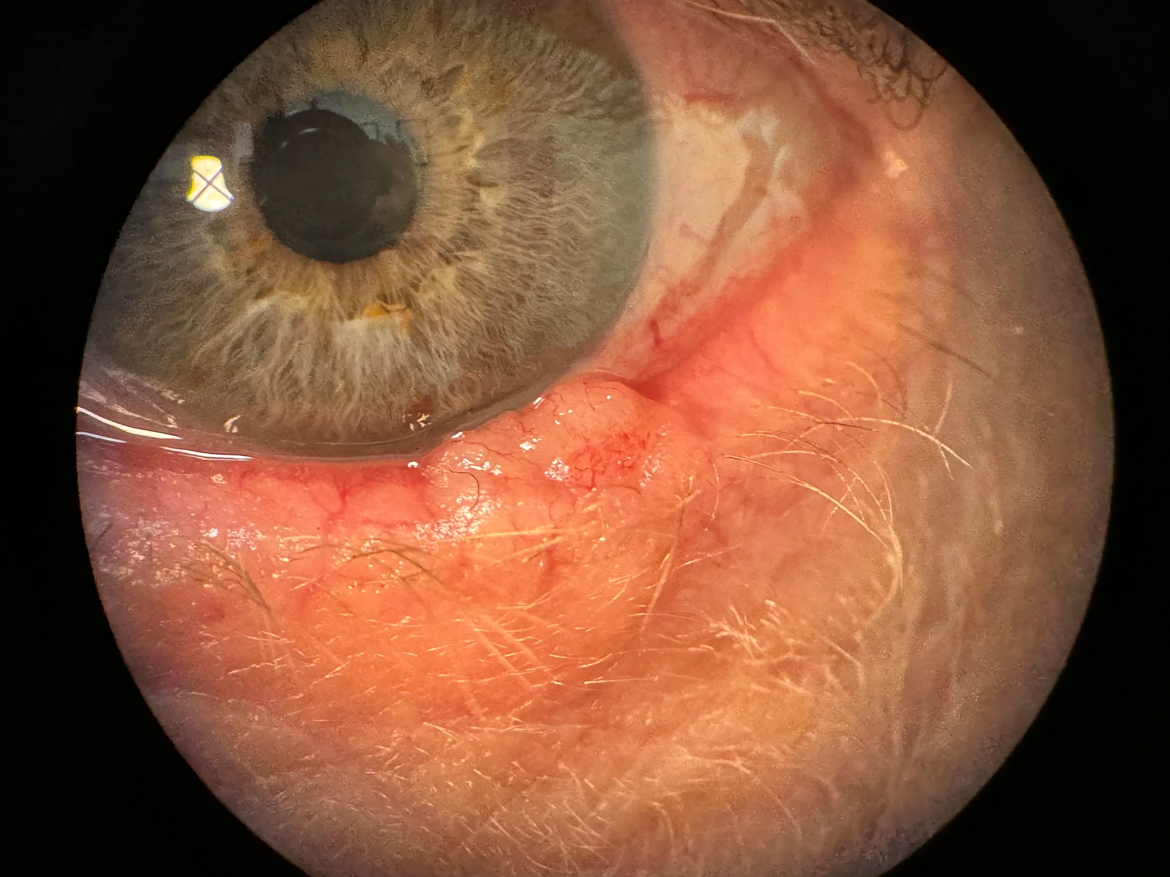 A persistent lump on the eyelid presenting for assessment