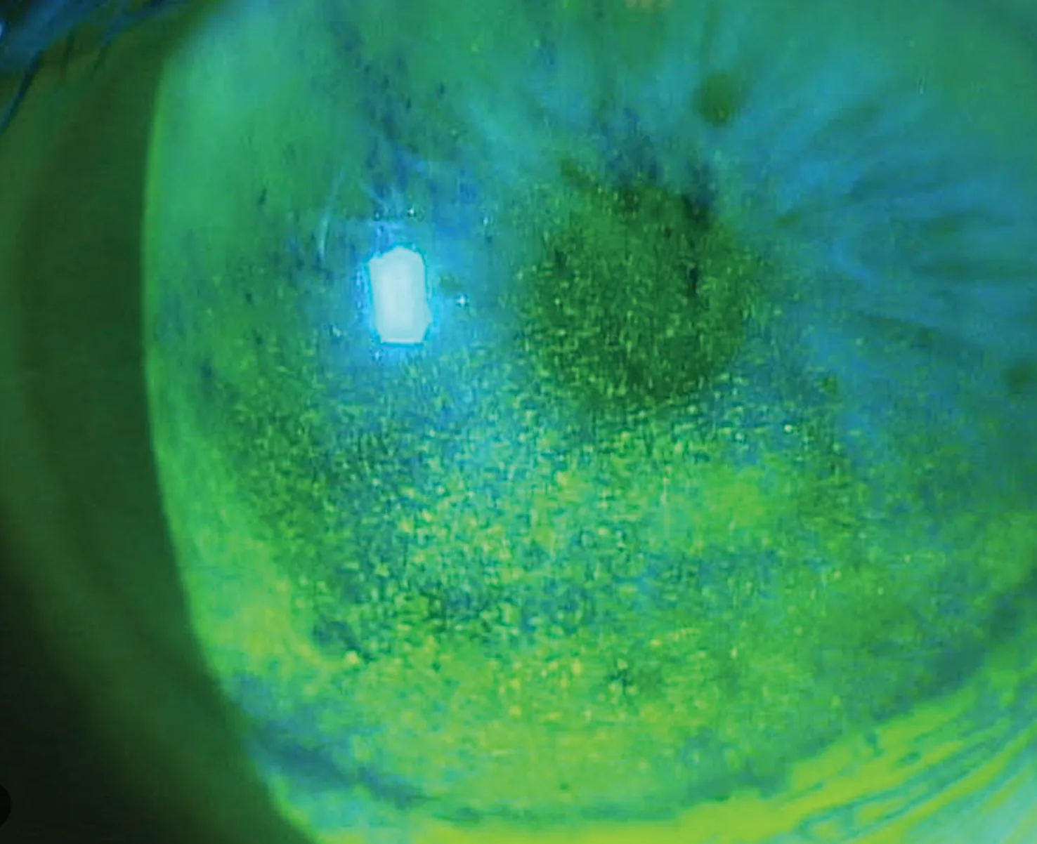 Slit-lamp photograph showing punctate epitheliopathy on the corneal surface