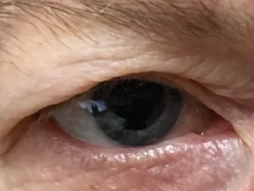 Excess upper eyelid skin obstructing the visual field